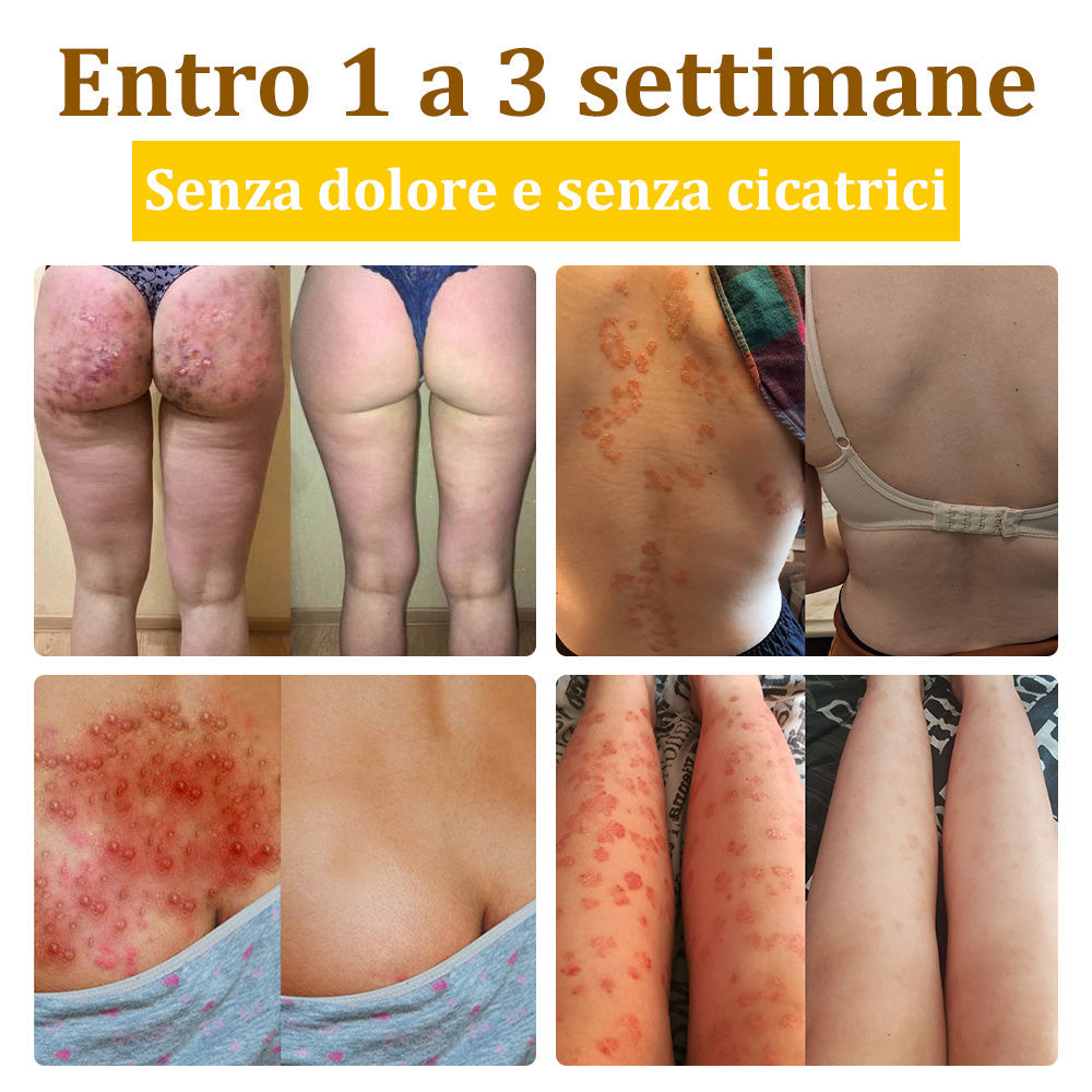 ✨flysmus™ Crema al Veleno d'Api per Più Benefici🐝:Tratta Eczema, Psoriasi, Acne, Rosacea, Infezioni Fungine, Verruche