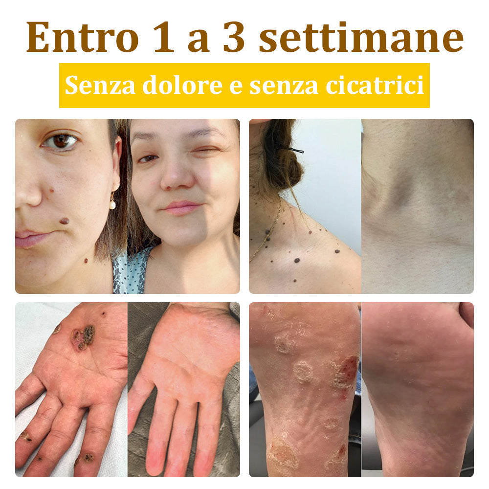 ✨flysmus™ Crema al Veleno d'Api per Più Benefici🐝:Tratta Eczema, Psoriasi, Acne, Rosacea, Infezioni Fungine, Verruche