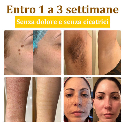 ✨flysmus™ Crema al Veleno d'Api per Più Benefici🐝:Tratta Eczema, Psoriasi, Acne, Rosacea, Infezioni Fungine, Verruche