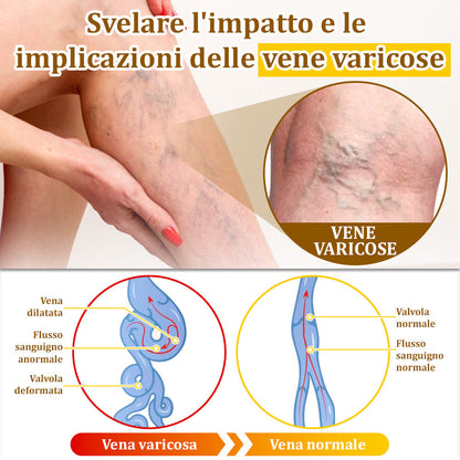 ✨flysmus™ Crema al Veleno d'Api per Più Benefici🐝:Tratta Eczema, Psoriasi, Acne, Rosacea, Infezioni Fungine, Verruche