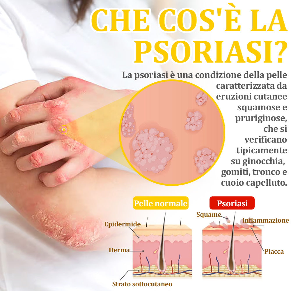 ✨flysmus™ Crema al Veleno d'Api per Più Benefici🐝:Tratta Eczema, Psoriasi, Acne, Rosacea, Infezioni Fungine, Verruche